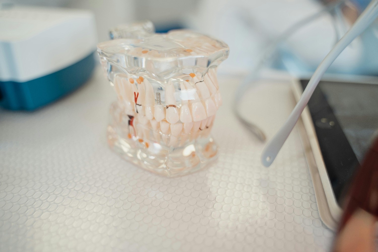 Single Implant Result